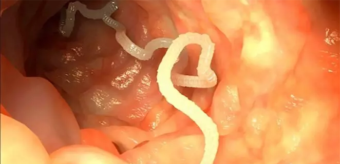 داء الديدان الشصية