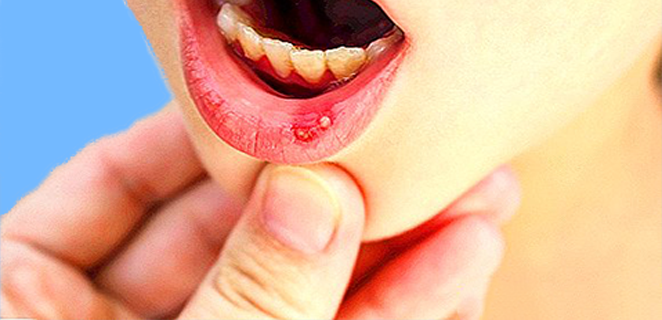 التهاب الفم الهربسي الاولي