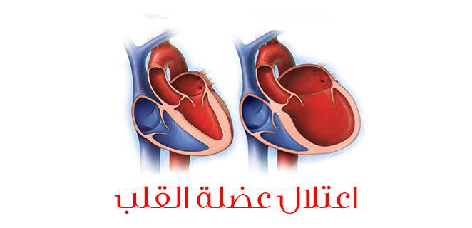 ضعف عضلة القلب اسباب اعراض وعلاج الطبي