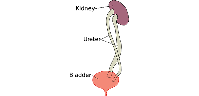 تضخم المثانة