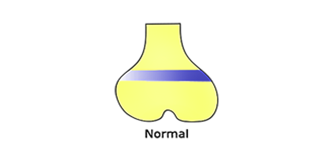 التهاب المشاش