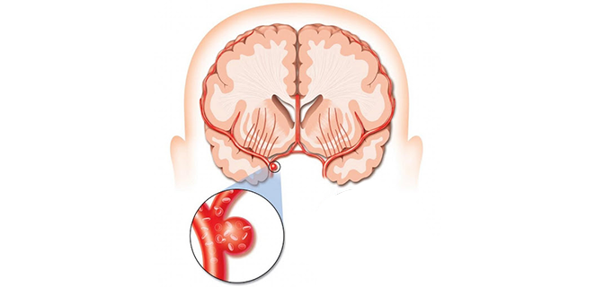 نزف تحت العنكبوتية
