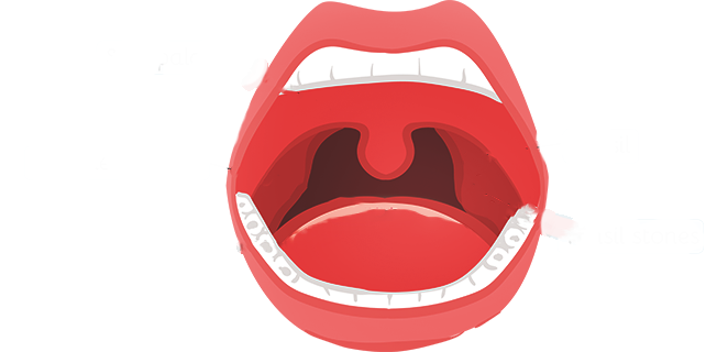 ارتخاء اللهاة