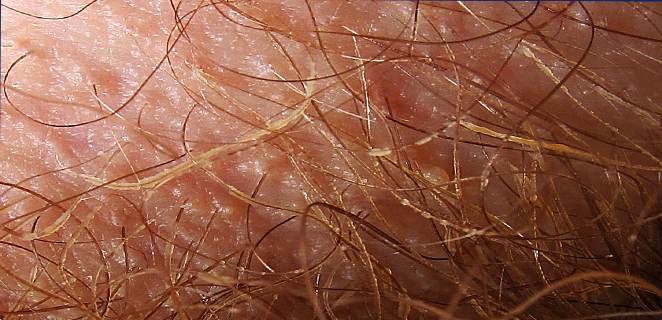 داء الفطريات الشعرية الابطي