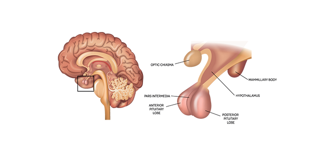 متلازمة لوران ليفي