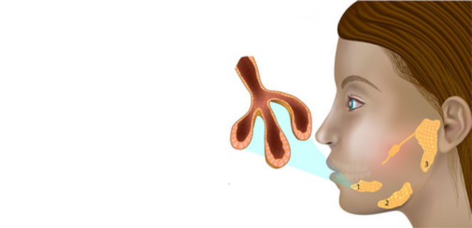 التهاب الاقنية اللعابية
