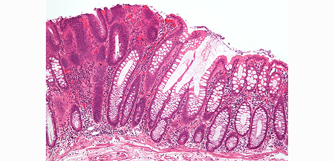 سرطانة غدية