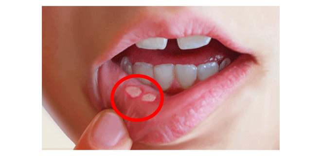 التهاب الفم القلاعي