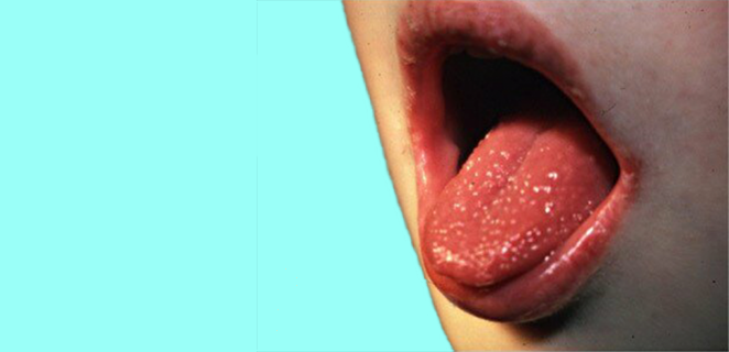 لسان الفراولة