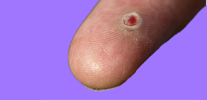 ورم حبيبي مقيح