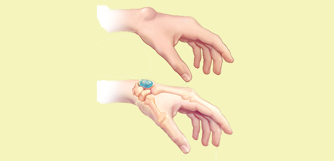 التكيس العقدي