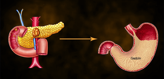 متلازمة زولنغر اليسون