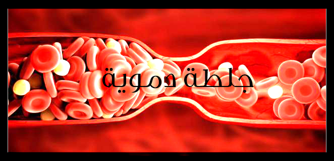 جلطة دموية