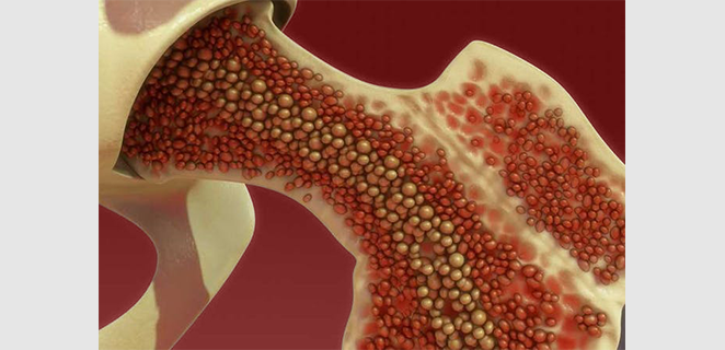 التهاب النقي و العظم الوتدي