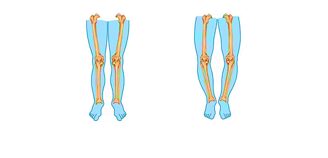 تلين العظام