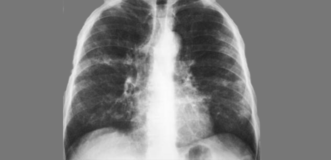 التهاب الاسناخ الارجي الخارجي