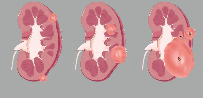 ورم كلوي كيسي