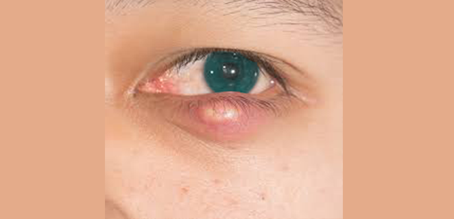 التهاب غدد ميبوميوس