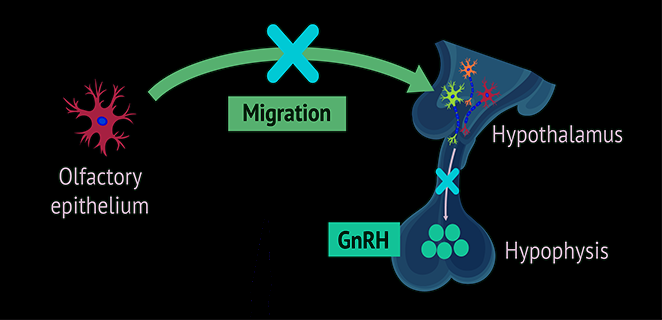 متلازمة كالمان