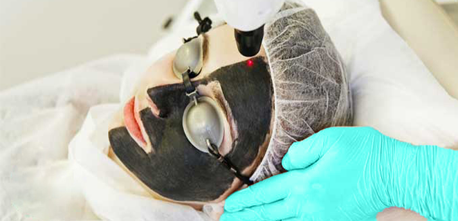 الليزر الكربوني