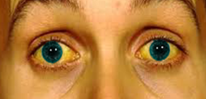 يرقان انحلالي