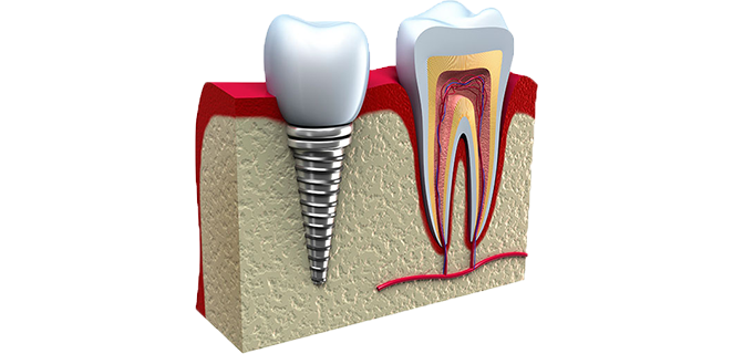 زراعة الاسنان
