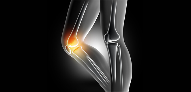 التهاب المفاصل والعظام التنكسي Degenerative Arthritis الطبي