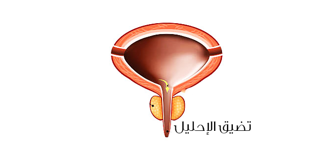 تضيق الاحليل