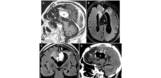 اعتلال بيضاء الدماغ