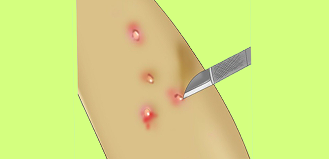 مليساء معدية