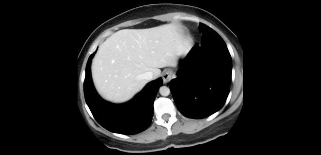 الاشعة المقطعية للكبد