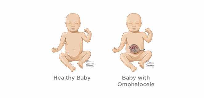 متلازمة اي ام جي