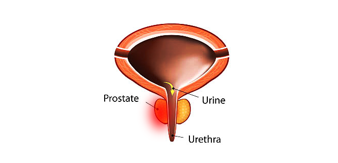 التهاب البروستاتا اللاجرثومي