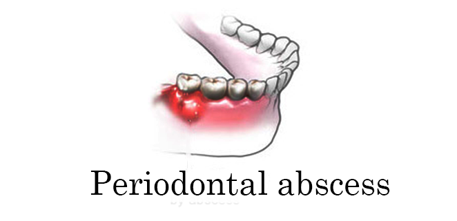 خراج دواعم السن