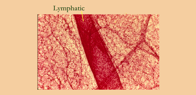 التهاب الاوعية اللمفية