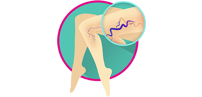 التهاب الدوالي