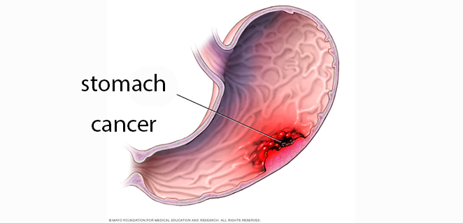 سرطانة المعدة الغدية