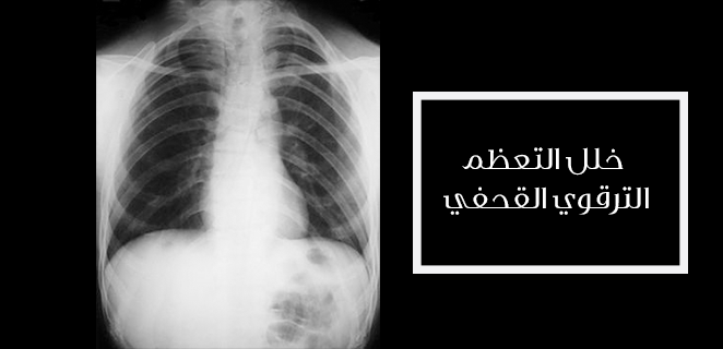 خلل التعظم الترقوي القحفي