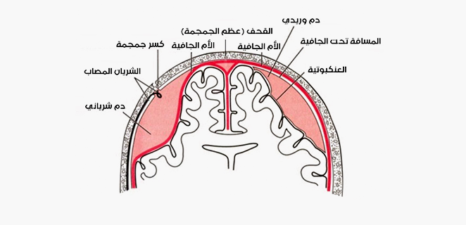 ورم دموي تحت الجافية