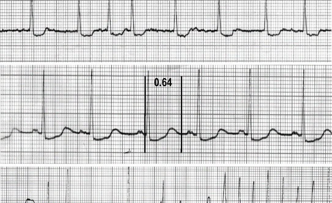 متلازمة فترة كيو تي الطويلة