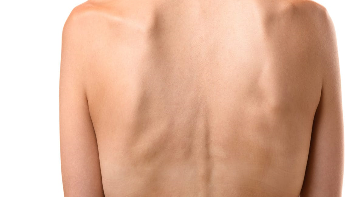 متلازمة هزال فيروس العوز المناعي البشري