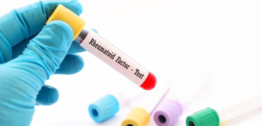 عامل روماتويدي