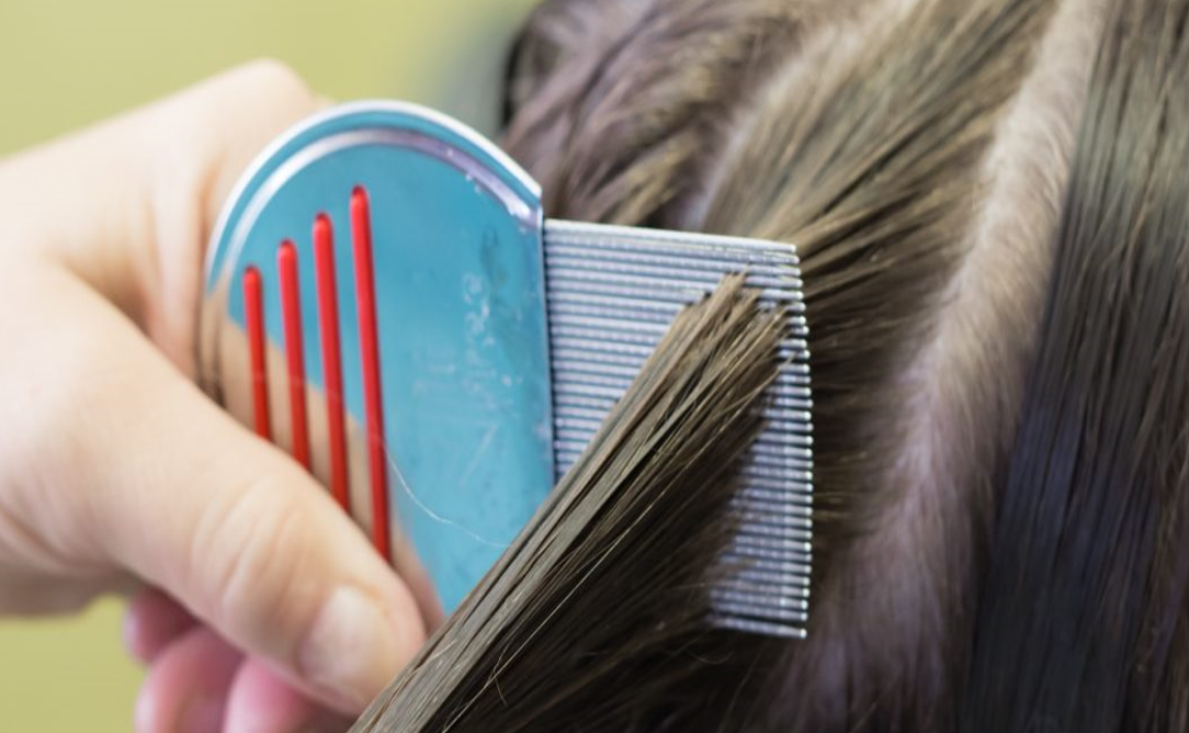 كيف يمكن التخلص من قمل الشعر؟