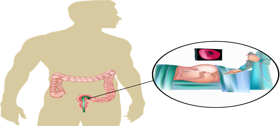 تنظير السيني