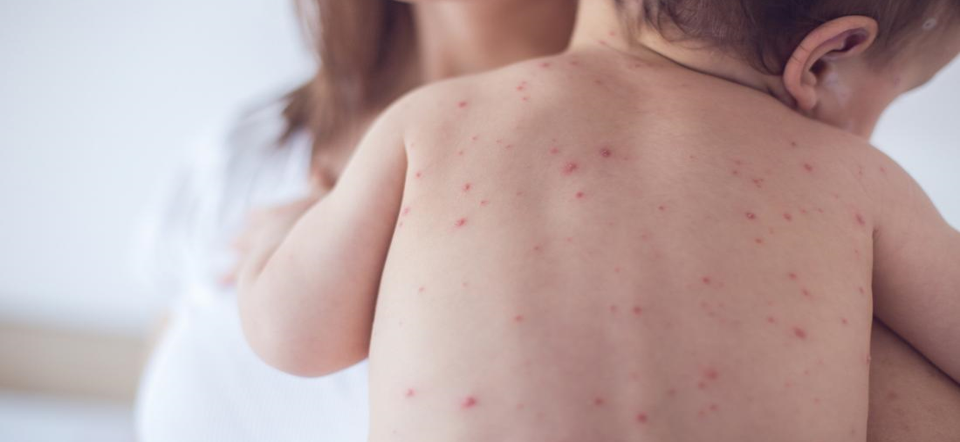 حصبة المانية