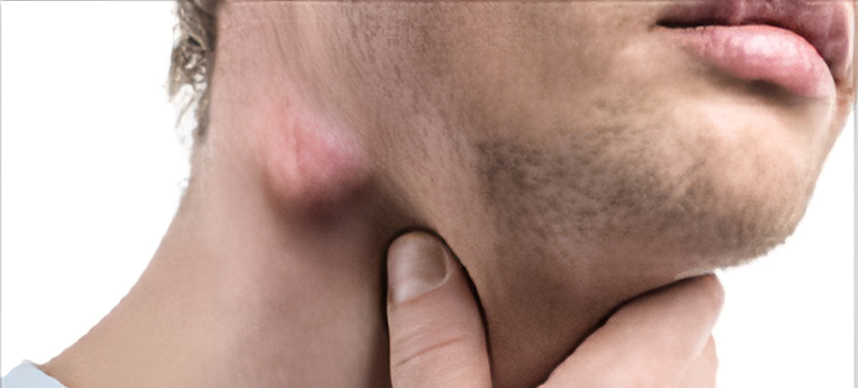 داء كاسلمان