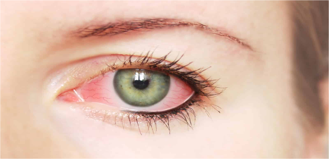 الم العين من اعراض كورونا