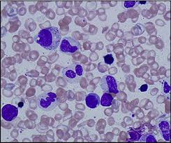 خلل التنسج النخاعي