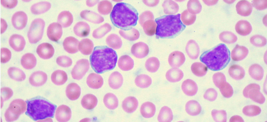 ابيضاض اللمفاويات الحاد