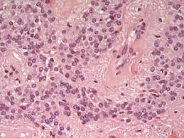 ورم البطانة العصبية